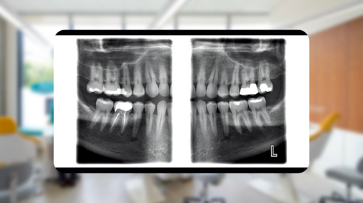 xray 4 Reasons to Use Panorex X-rays for Bitewings